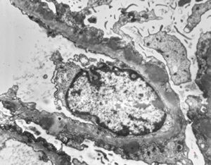 M,58y. | membranous glomerulopathy -early stage